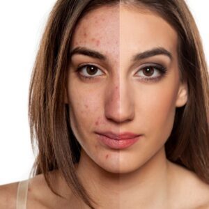 A woman with acne and dark spots on her face.